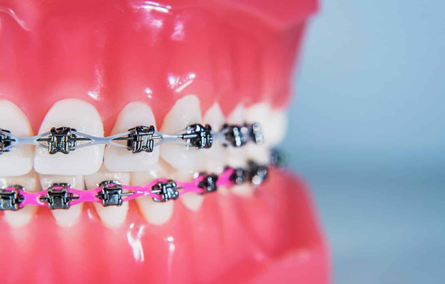 Invisalign & Orthodontics Alpharetta, GA Dentist Dental Town